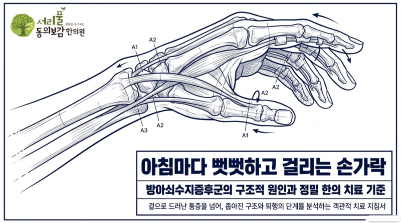 손가락이 굽은 채로 안 펴지고 딱 걸린다면 | 서초 방아쇠수지증후군 한의원