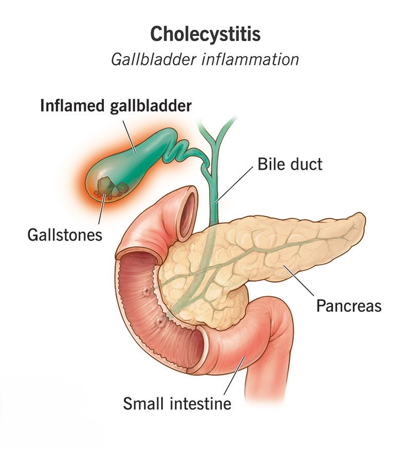 담석증 Gallolithiasis·담낭염 Cholecystitis: 돌 하나가 밤을 깨우는 순간
