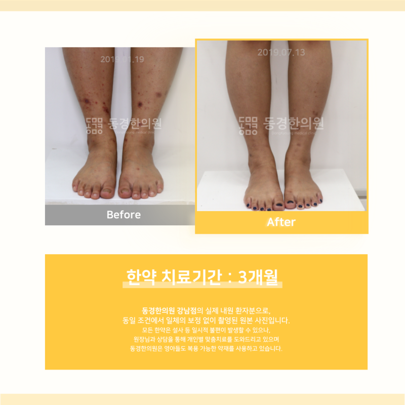 자반증 원인부터 증상까지, 현직 한의사가 정리해 드립니다.