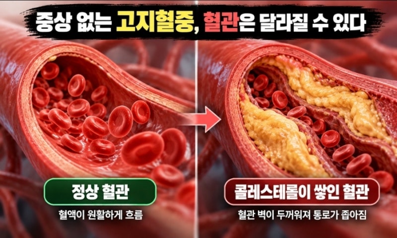 고지혈증 수치 높다고 무조건 약 먹어야 할까? 콜레스테롤 정상수치와 꼭 알아야 할 기준