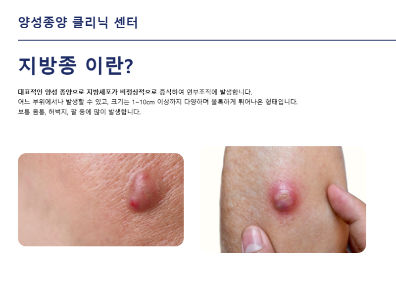 인천 표피낭종 제거수술｜얼굴에 낭종, 더나눔병원 성형외과