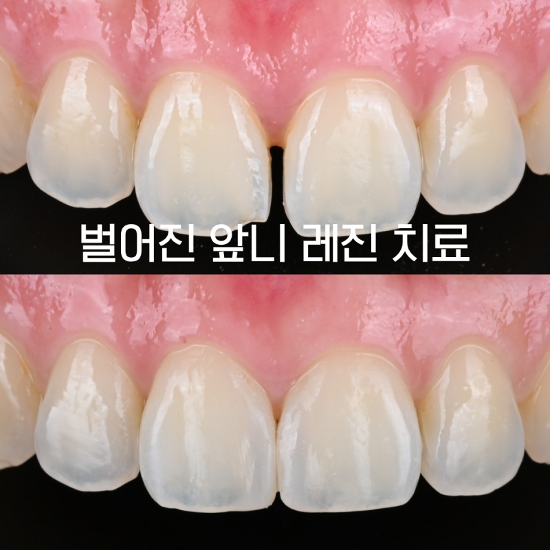 교정 후 앞니 사이가 다시 벌어졌다면? 벌어진 앞니 레진 치료 과정 | 부천중동치과