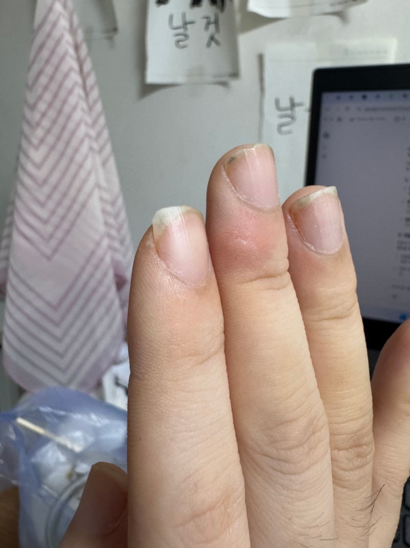 화상 입은 자리에 또 화상을 입었어요! ...올해만 화상을 몇번째 입는지 모르겠네요.
