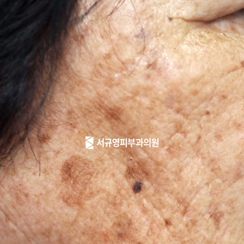 김천피부과전문의 검버섯 vs 피부암 차이 (색, 크기, 모양, 증상 등)