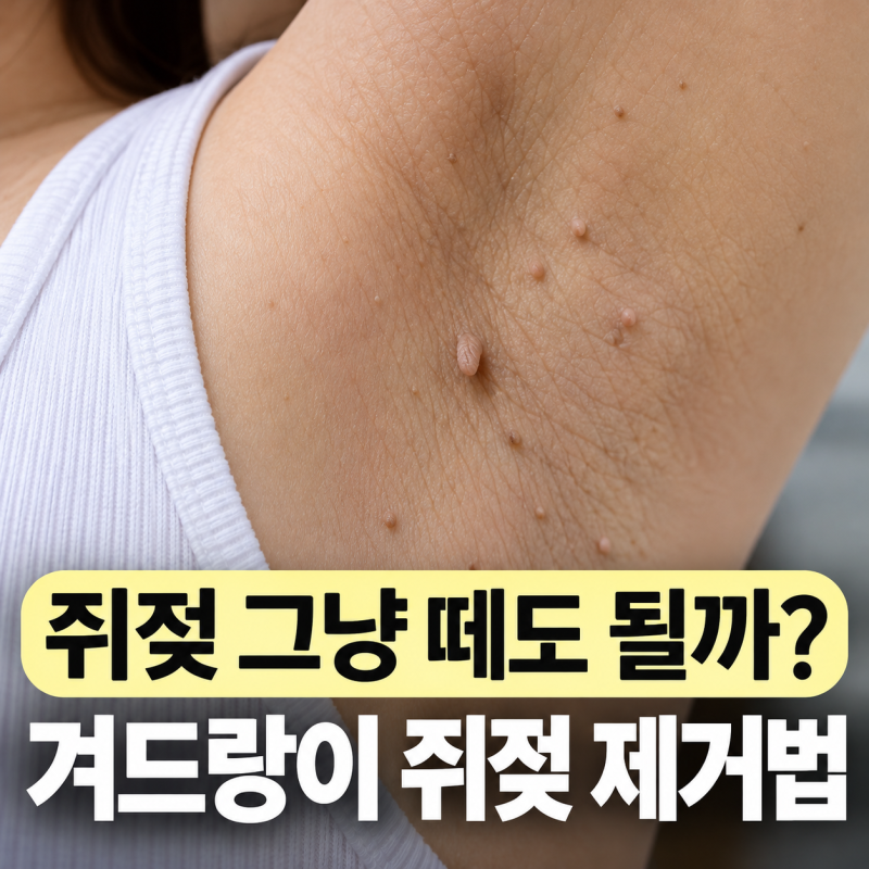 겨드랑이 쥐젖 제거하는 방법 집에서 뜯어도 될까