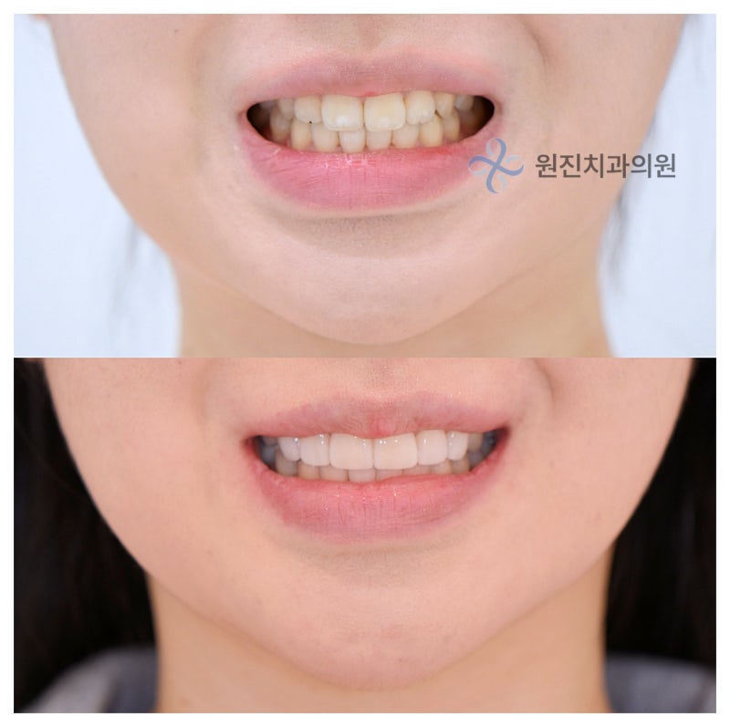 앞니 라미네이트 가격 2개 4개 6개 비용이 다른 이유는?