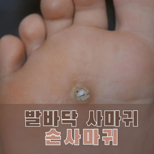 발바닥사마귀 티눈과 구별법, 사마귀냉동치료가 손사마귀보다 오래 걸리는 이유