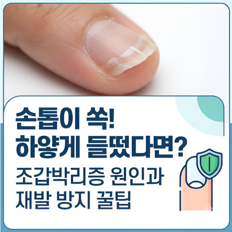 손톱이 자꾸 살에서 들뜬다면? 조갑박리증 원인부터 재발 막는 현실적인 관리 꿀팁