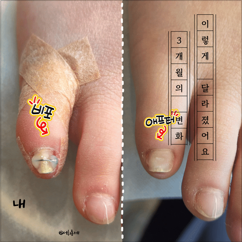 광주 무좀 내성 발톱 병원 수완지구 친구와 동행한 3개월 교정 기록