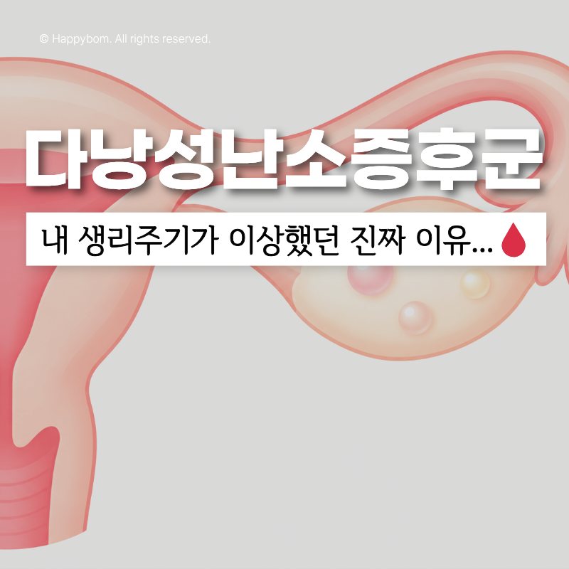 "내 생리주기, 왜 이상했을까?"다낭성난소증후군 신호