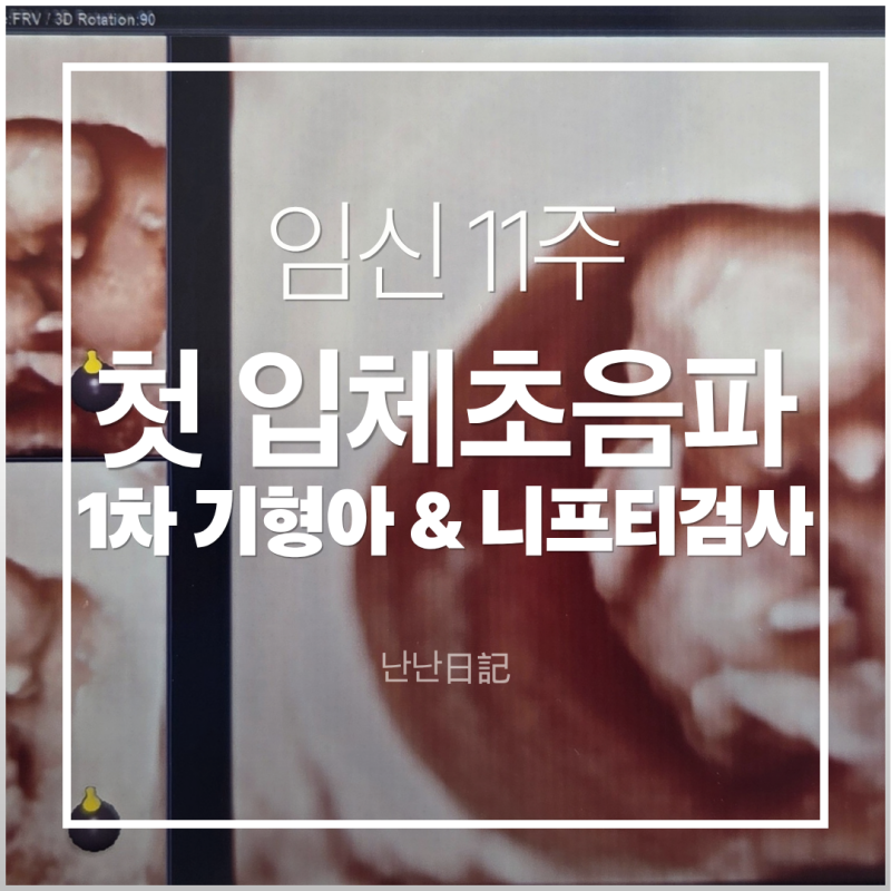 임신 11주차 | 첫 입체초음파, 1차 기형아 검사, 니프티 검사 후기