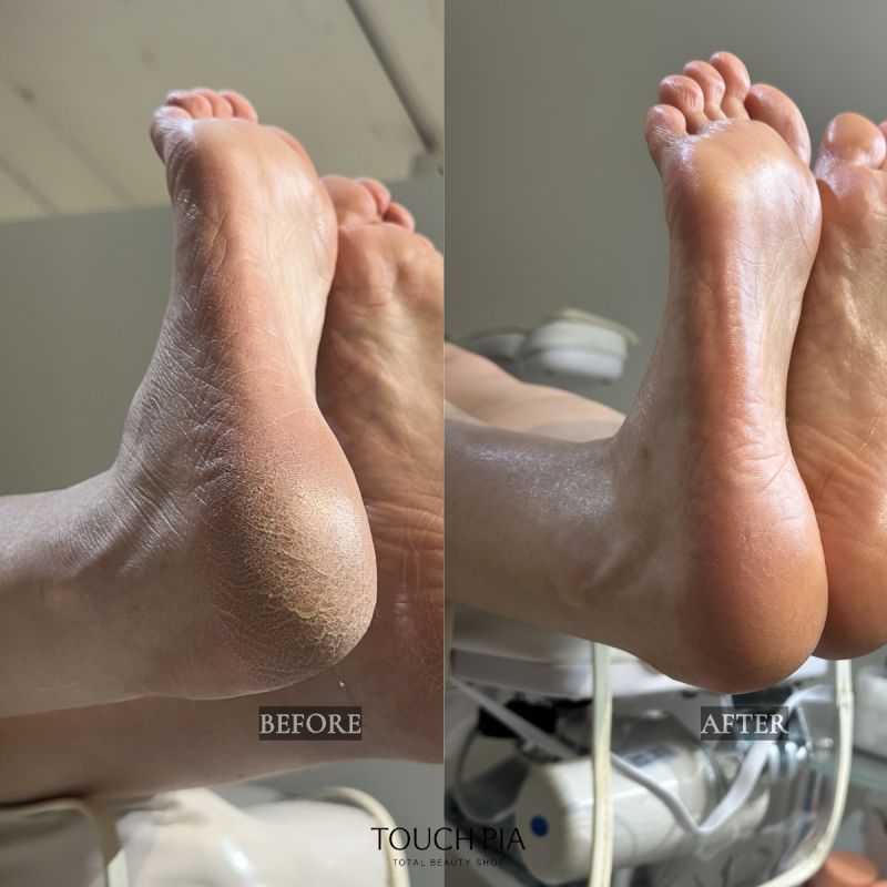발뒤꿈치 각질 갈라지기 전 알아두면 좋은 관리법