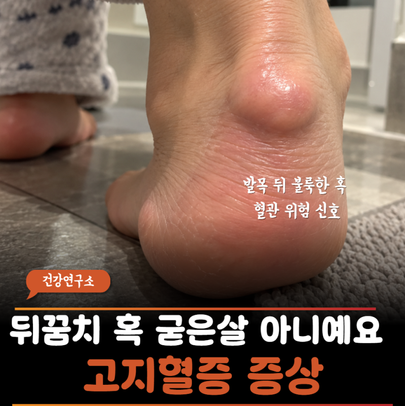 "가족성 콜레스테롤이란게 있다고?" 발목 뒤가 불룩해서 살찐 줄 알았는데… 아킬레스건 황....