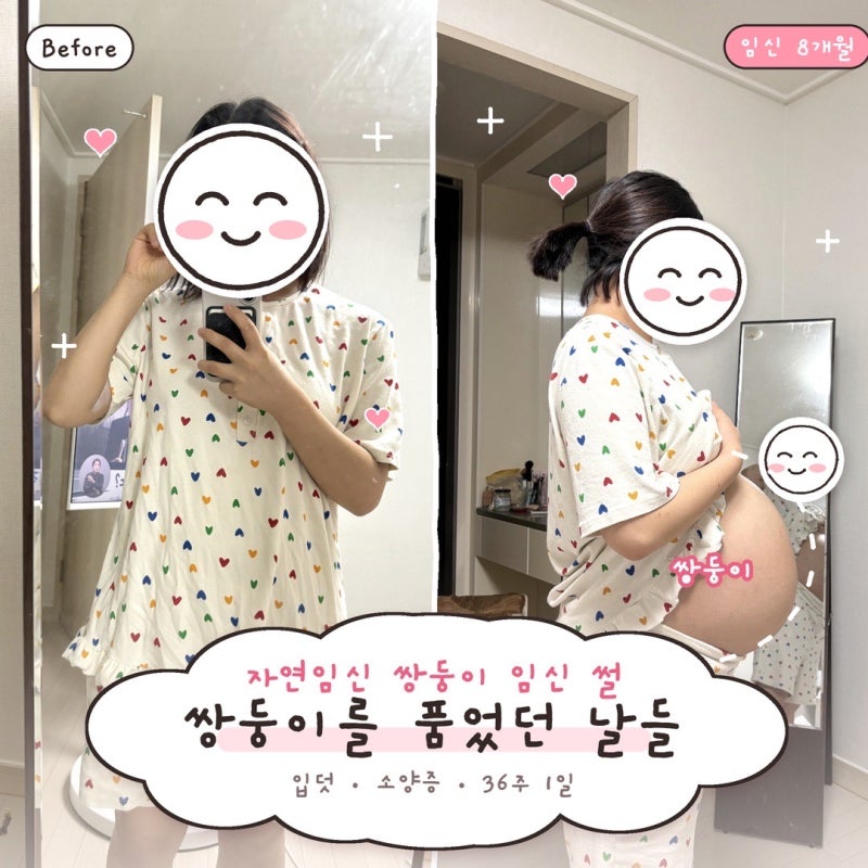 자연임신 이란성 쌍둥이 임신 썰｜입덧, 소양증, 그리고 매일 마음 졸였던 날들