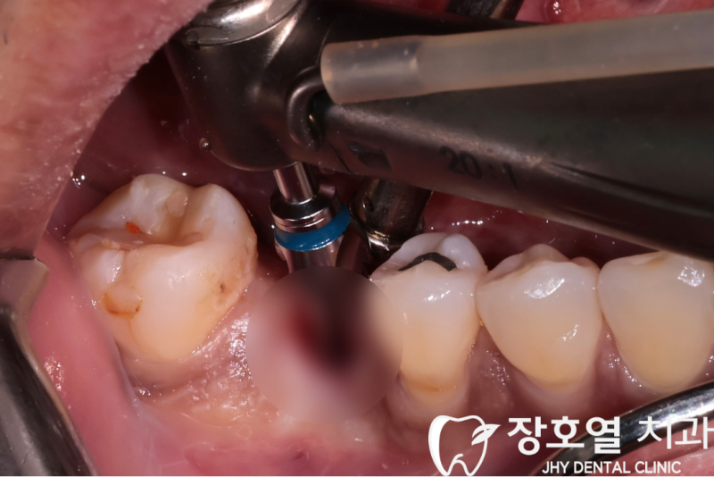 임플란트, 왜 장호열치과는 접착제보다 스크류 타입을 선택할까요?
