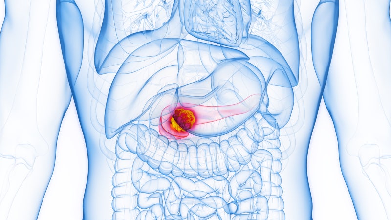 CT에선 정상인데 췌장암? 췌장암 조기 발견을 위한 췌장 MRI 검사의 모든 것 #가족력