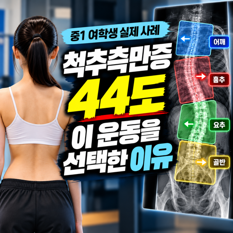 척추측만증 교정, 무작정 운동하면 될까? 중1 여학생 44도 실제 사례