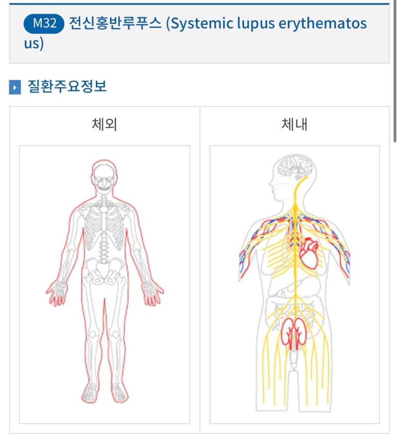 루푸스병이란? 초기 증상부터 원인, 치료 방법까지 총정리