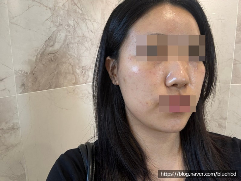 (리터치 후기) 얼굴 편평사마귀 제거 경과 후기2 (부산,가격, 재생크림)
