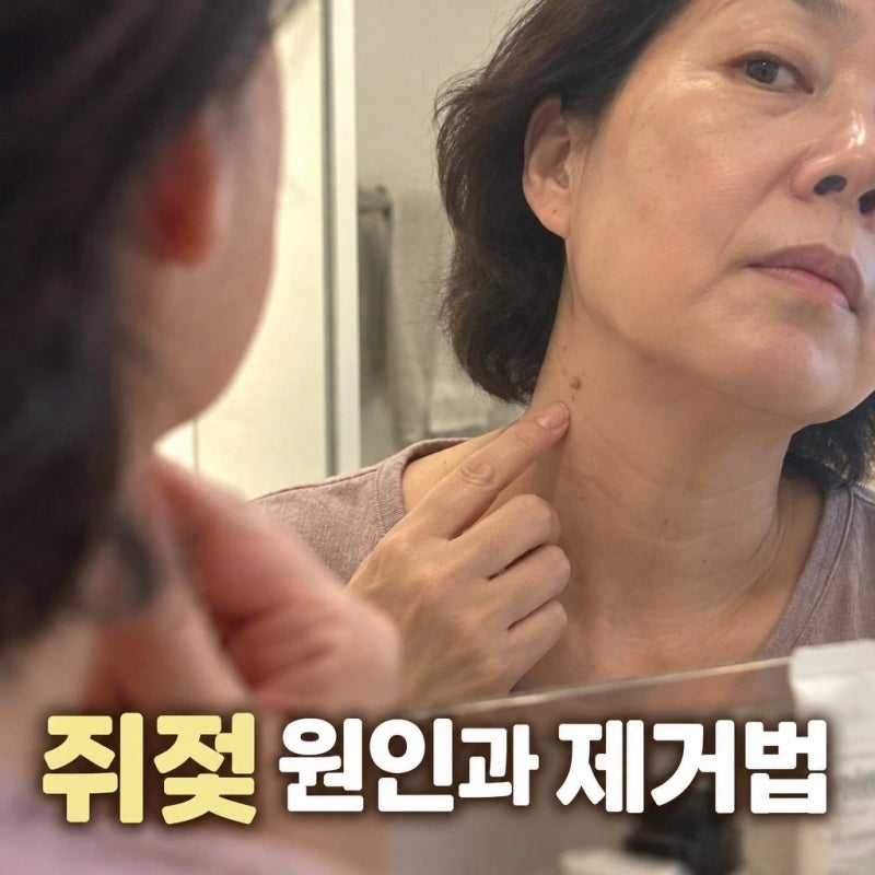나이들면 당연히 생긴다? 쥐젖 원인부터 없애는법. 비용. 관리. 예방 수칙까지