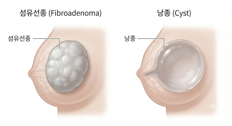 “유방 초음파에서 혹이 보인대요”… 유방 결절 BI-RADS 등급별 의미와 추적 검사