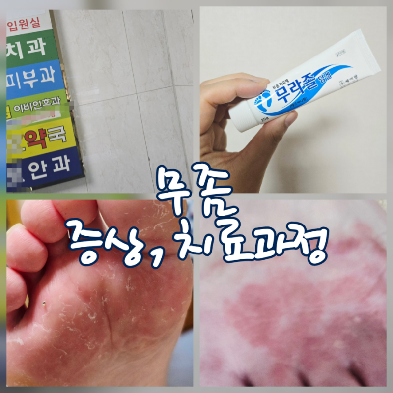 무좀 증상 치료 병원 치료방법 무좀연고