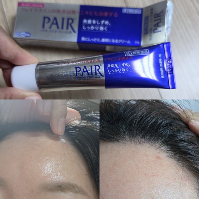 일본 드럭스토어 구매 여드름 연고 페어 사용후기