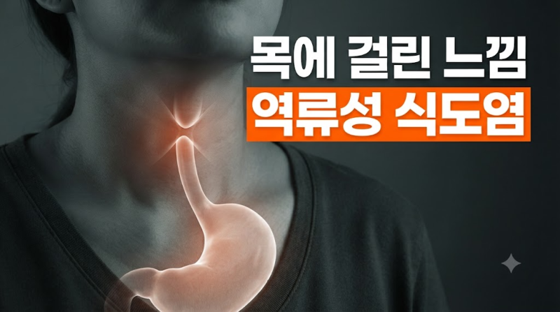 목에 뭔가 걸린 느낌, '역류성 식도염' 완화를 위한 생활 습관과 위장 보호 영양제