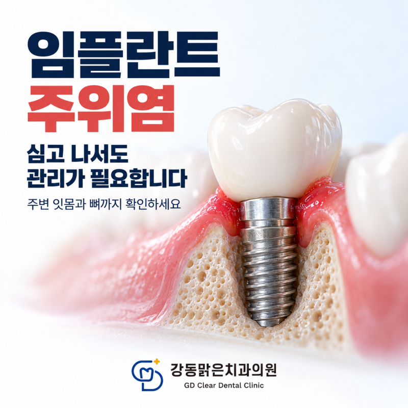 천호 임플란트 사후관리, 잇몸 출혈과 주위염을 확인해야 하는 이유