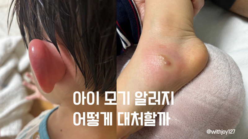 아기 모기 알레르기 스키터증후군 증상｜심한 붓기·열감, 소아과 처방 후기