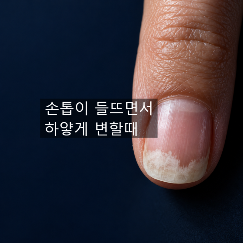 손톱이 들뜨면서 끝부분이 하얗게 변하는 이유, 무좀일까요?