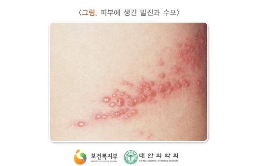 암 환자의 대상 포진 증상과 통증 치료