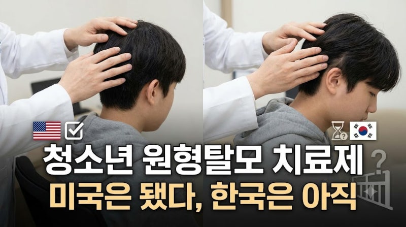 청소년 원형탈모 치료제, 미국은 됐는데 한국은 아직