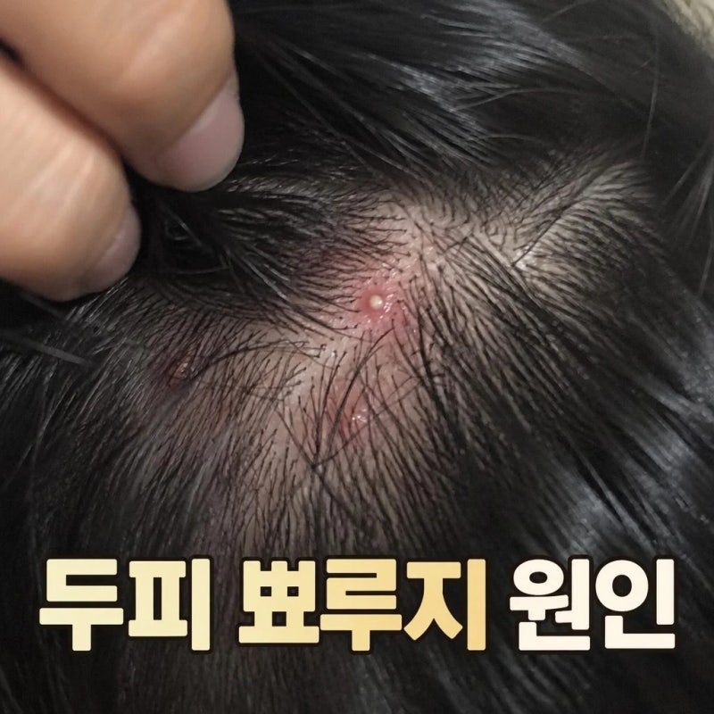 머리 속 자주 생기는 두피 뾰루지 여드름 원인