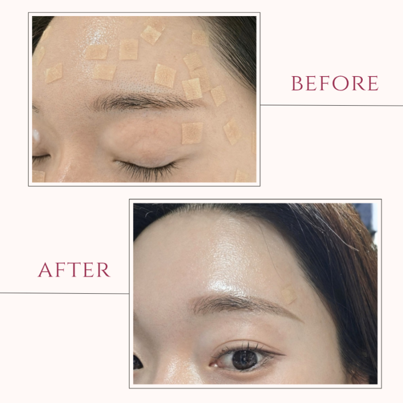 강남역 편평사마귀 무제한 제거 HPV치료성지 꼼꼼하고 친절했던 후기 / 1~9일 회복 과정(+관리....