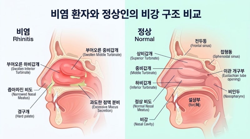 비염·비중격만곡증 수술 vs 미용 코성형(기능코) 실손보험 청구 가이드