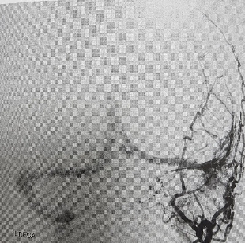 Transradial Cerebral Angiography (TRCA), 요골동맥 접근 뇌혈관조영술