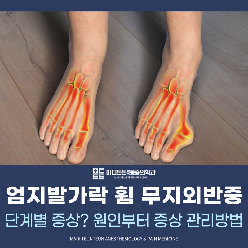 엄지발가락 휨 무지외반증 단계별 증상? 원인부터 증상 관리방법까