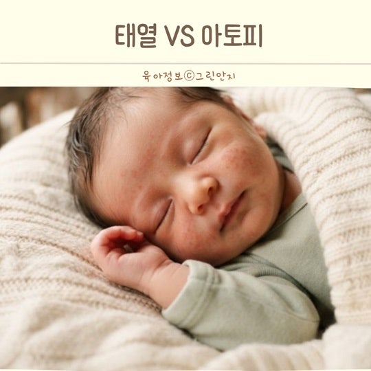 신생아 태열 아기 얼굴에 오돌토돌 올라왔다면 아토피와 구별하는 방법