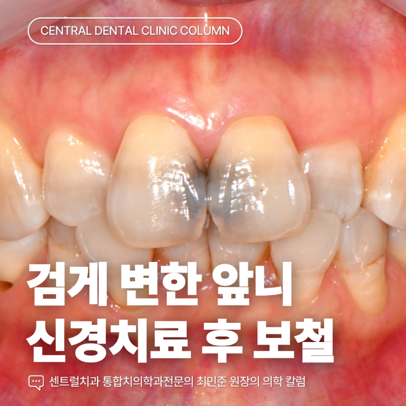 앞니가 심하게 상해 신경치료가 필요하다면?