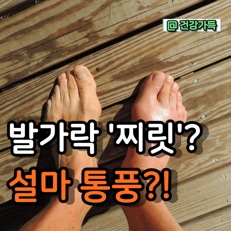 새벽마다 발가락이 찌릿하고 아프다면? 이미 늦습니다! 2030을 위협하는 통풍 초기증상과 피....