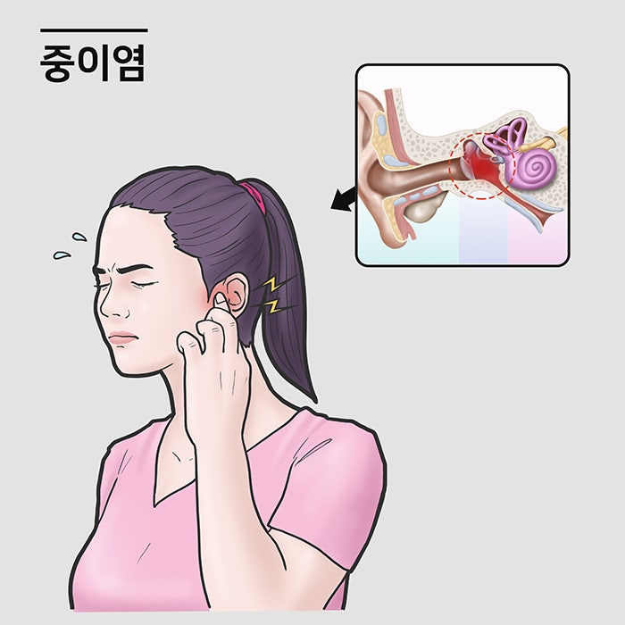 "귀에서 고름이 나고 소리가 잘 안 들린다면?" '만성 중이염' 원인과 수술 치료법!