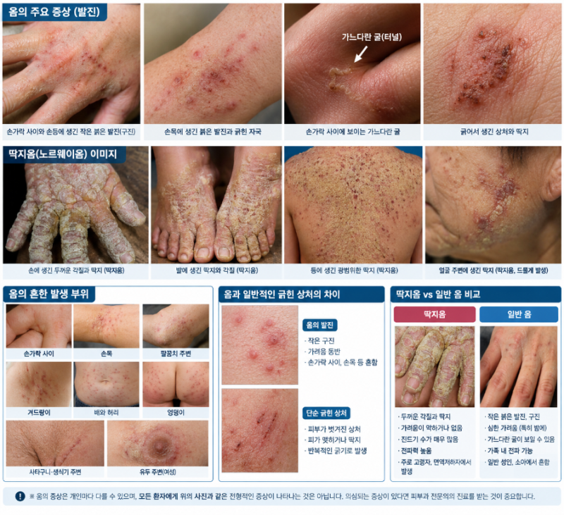 "밤마다 온몸이 가렵다면?" '옴'의 증상부터 전염 경로, 진단, 치료 방법, 전염력, 세탁법, 합....
