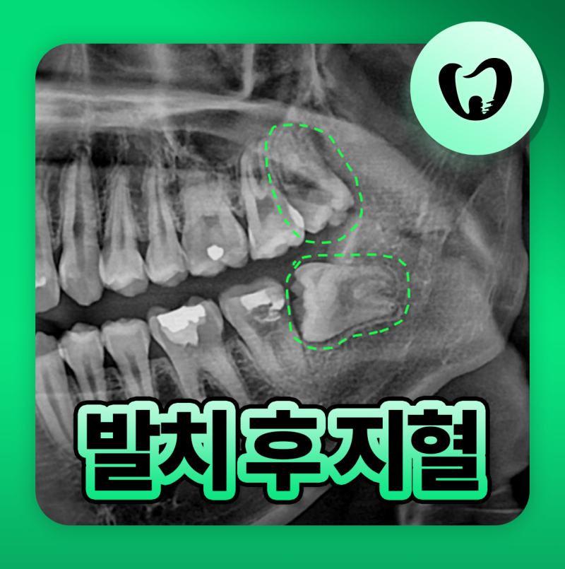 동래역치과 사랑니 발치 후 피 언제까지? 거즈 지혈 방법