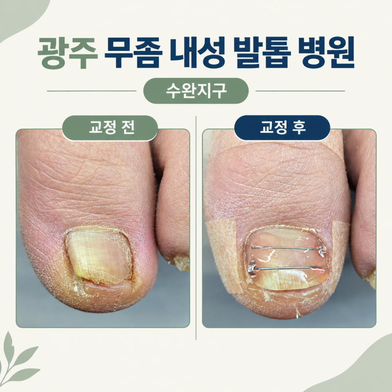 광주 무좀 내성 발톱 병원 수완지구 내성발톱 치료 후기