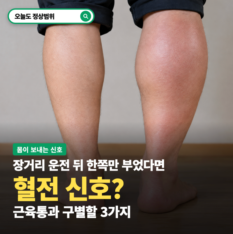 운전 피로인 줄 알았던 한쪽 다리 붓기, "혈전 신호"일 수도 있을까요?