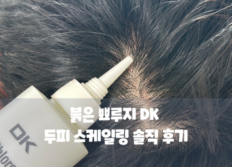 정수리 냄새 두피 빨감 고민 끝 1년 고생한 붉은 뾰루지 DK 두피 스케일링 솔직 후기