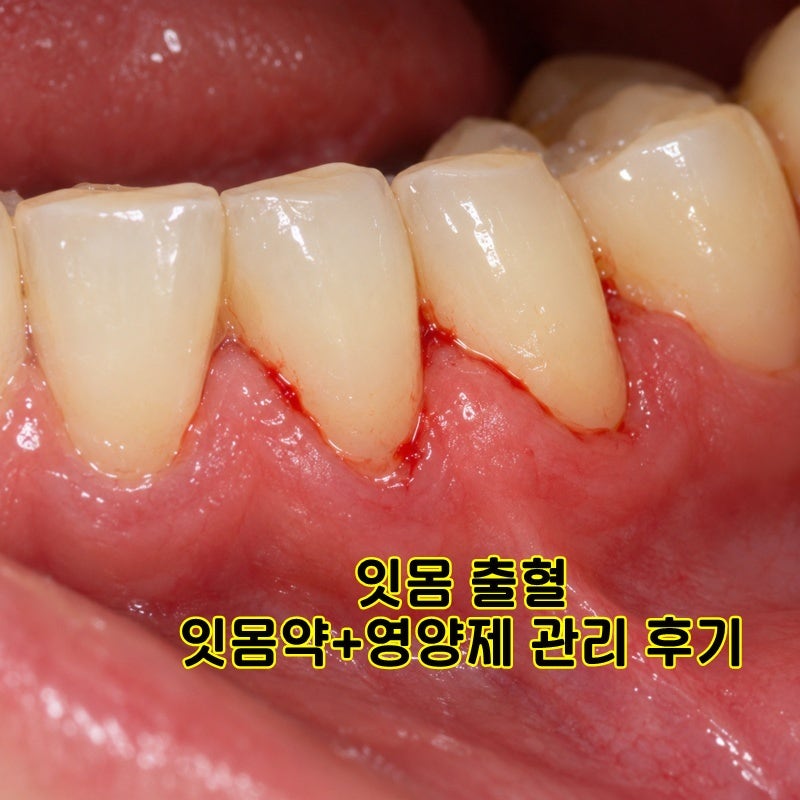 잇몸약 종류 출혈 붓기 변화기록