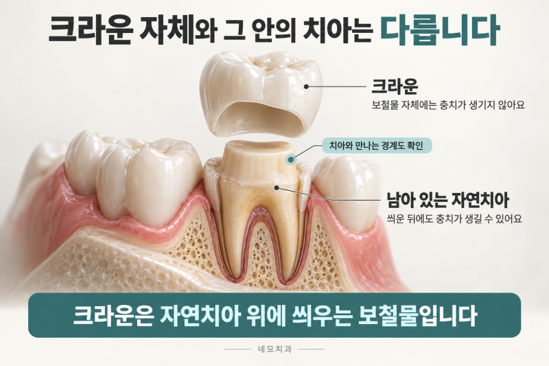 크라운 씌운 치아, 충치 걱정은 끝일까요?_선릉역치과