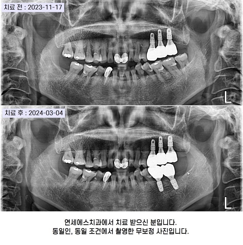 치아 잇몸 통증 부음 어금니가 아파요 발치 임플란트